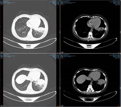 Metagenomic next-generation sequencing clinches the diagnosis of Legionella pneumonia in a patient with acute myeloid leukemia: A case report and literature review